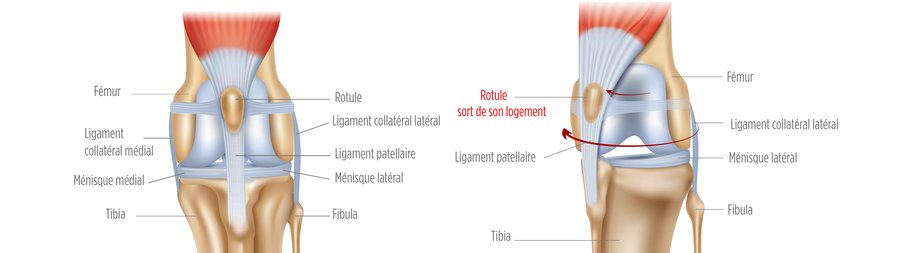 Schéma anatomique du genou du chien : rotule normale et rotule luxée